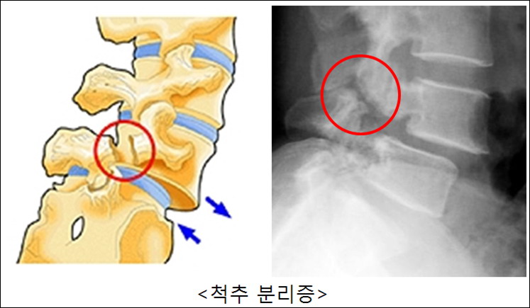 퇴행성 디스크 파열, 디스크 치료.수술과 척추 분리증. 척추 전방 전위증의 치료 원인, 증상, 증상, 약, 주사. 수술, 운동, 척추 전방 전위증 수술. 척추 고정술 예방 및 완치 후기 2